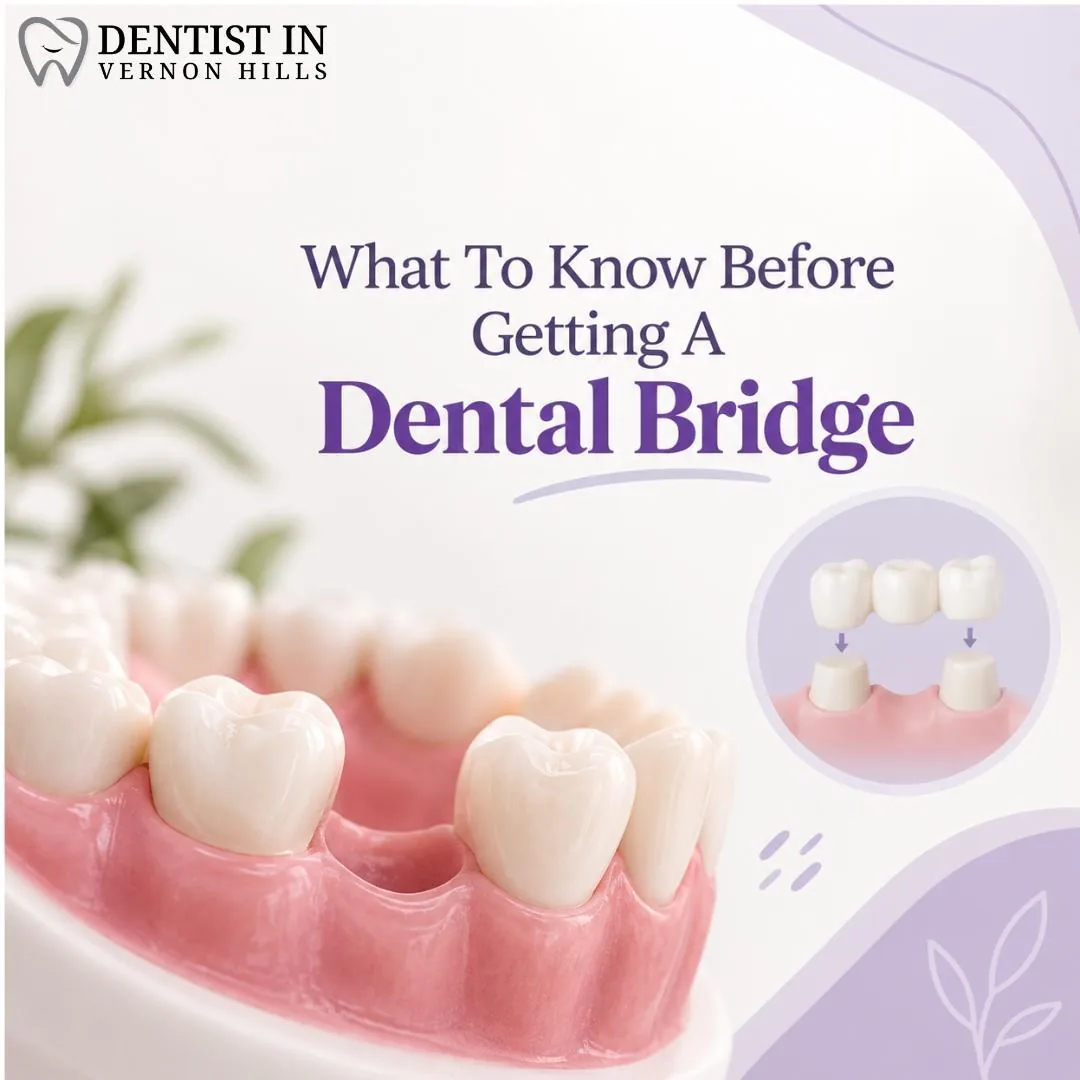 What To Know Before Getting A Dental Bridge