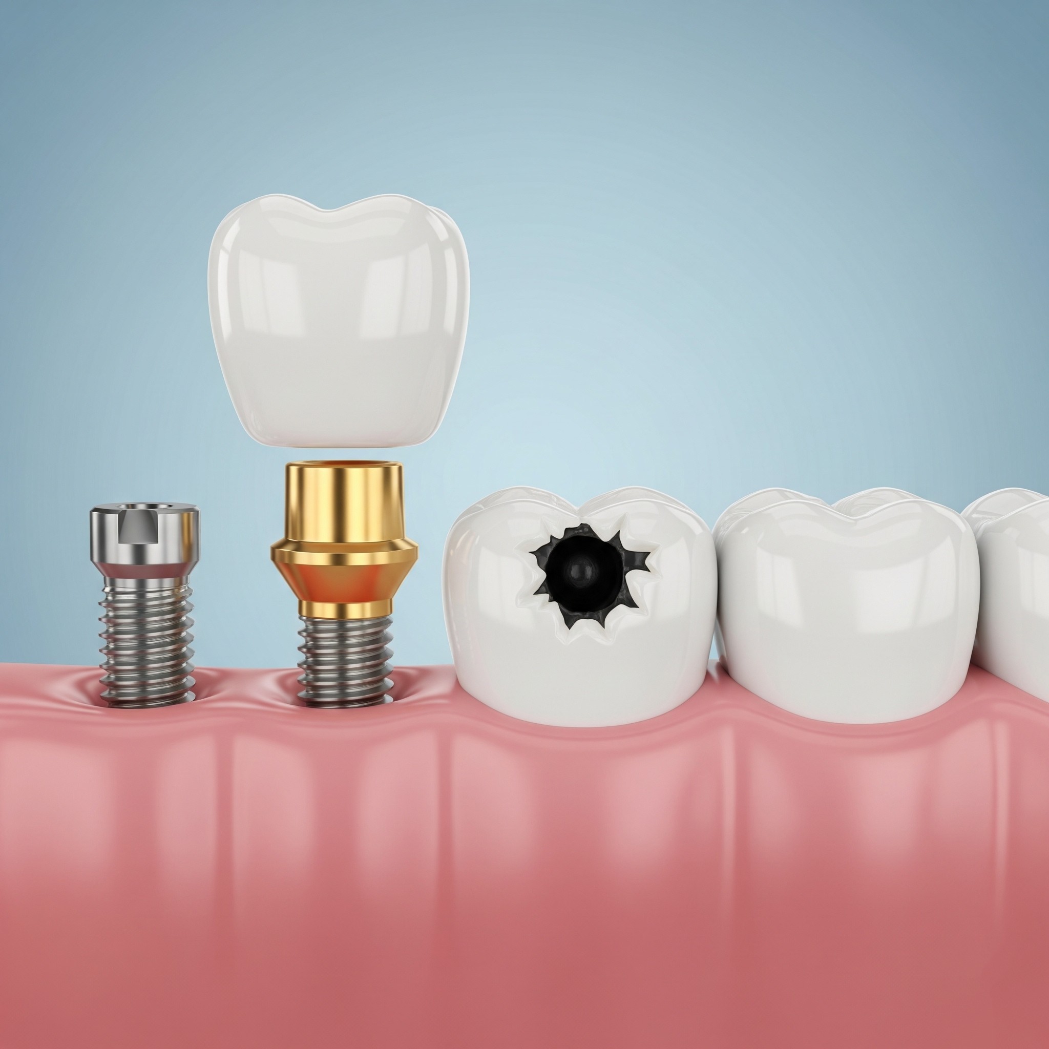 what-is-tooth-restoration