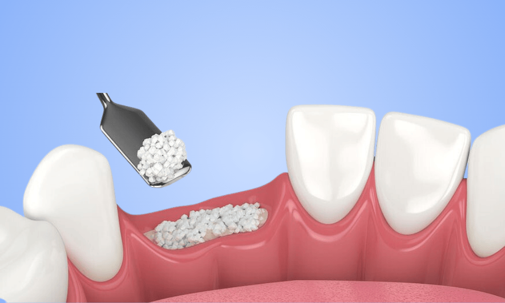 Why Choose Bone Grafting in Vernon hills?