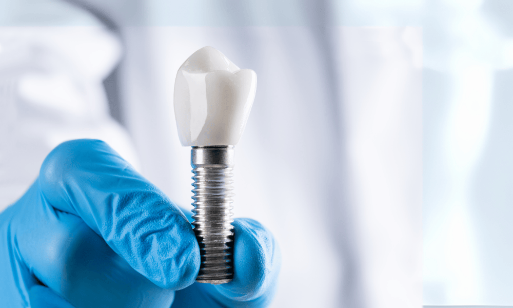 Why Choose Dentist in Vernon hills for Dental Implants?