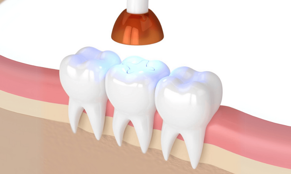 Composite Fillings Cost and Pricing Information in Vernon hills