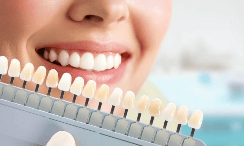 Pros and Cons of Veneers